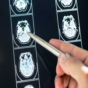 neurological disease treatment